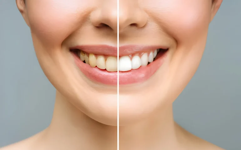 TOOTH WHITENING